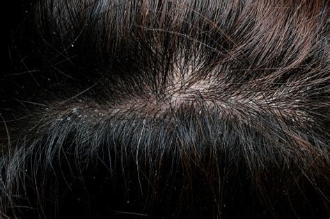 Dandruff On Black Hair Stock Photo Download Image Now Istock