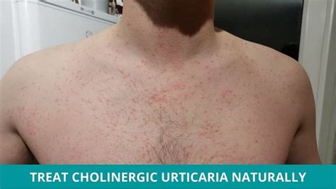 Cholinergic Urticaria