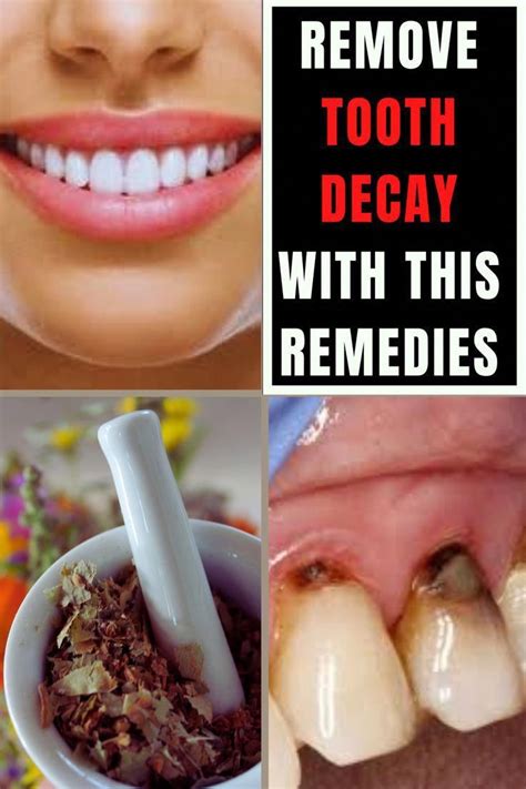 Get Rid Of Cavities And Tooth Decay Sharon Marcello Artofit