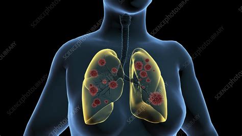 Infected Lungs 3d Illustration Stock Image F0299484 Science