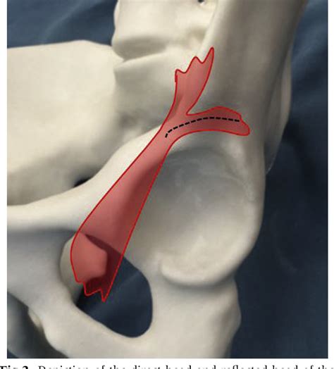 Figure 3 From Arthroscopic Labrum Reconstruction In The Hip Using The