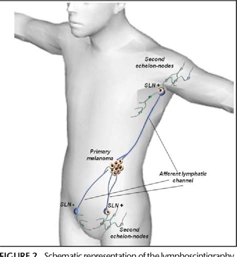 Figure 2 From Sentinel Lymph Node Biopsy For Cutaneous Melanoma