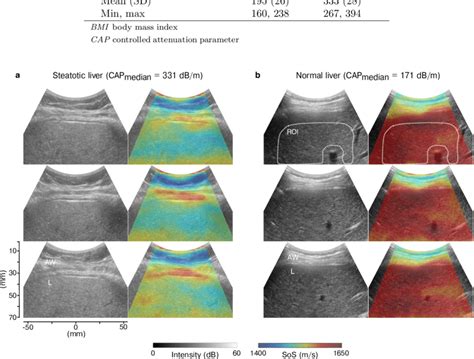 Example images of ultrasound B-mode and CUTE speed of sound in a normal ...