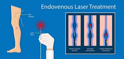 Nm Nm Evlt Diode Laser Ce Medical Endovenous Ablation Of