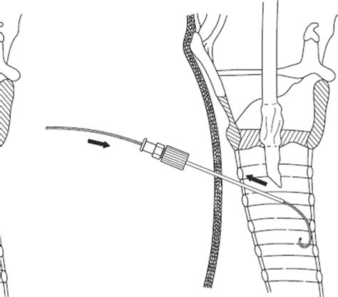 Percutaneous Dilatational Tracheostomy Semantic Scholar