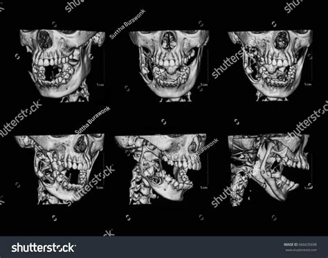 21 Tumors Jaws 3d Images Stock Photos Vectors Shutterstock