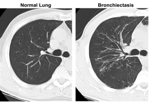 Baker: ePneumonia, Bronchiectasis, Lung Abscess and Pleural Effusion Flashcards | Quizlet