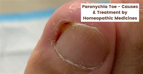 Paronychia Toe Paronychia Healing Stages With Homeopathy 55 OFF