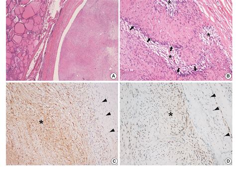 [pdf] Primary Neurilemmoma Of The Thyroid Gland Clinically Mimicking Malignant Thyroid Nodule