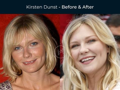 26 Celebrity Dental Implants And Veneers Before And After Photos