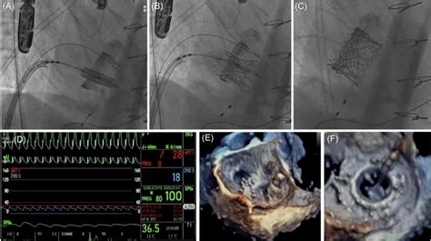 Percutaneous Valveinvalve Transseptal Mitral Valve Implantation