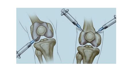 Picante Condicional Habilitar Infiltracion De Corticoides En Rodilla