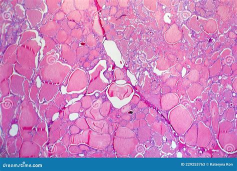 Follicular Adenoma Of Thyroid Gland Stock Image | CartoonDealer.com ...