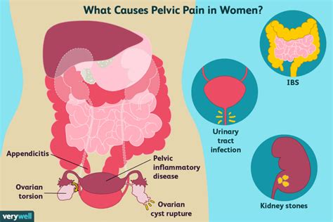 Understanding Chronic Pelvic Pain: Causes And Treatments - Ask The ...