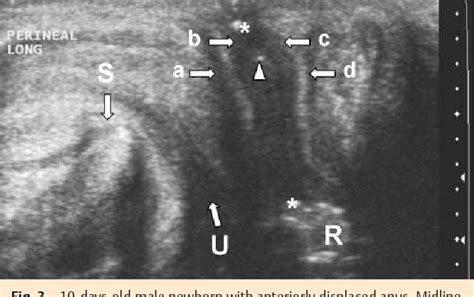 Figure From Transperineal Sonography Of The Anal Sphincter Complex In