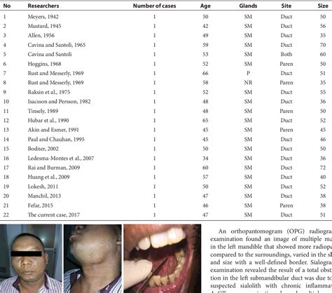 Table 1 From Sialolithotomy And Sialodochoplasty Of Giant Sialolith In