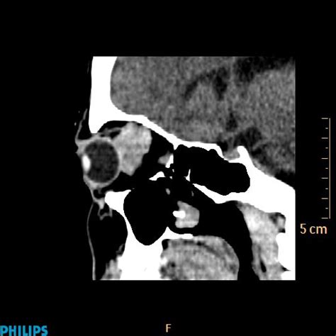 Retrobulbar Hematoma Image