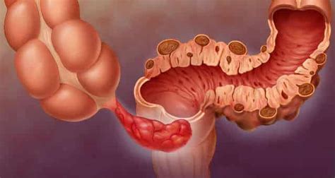 La Diverticulitis Aguda ¿qué Es Síntomas Dieta Y Tratamiento