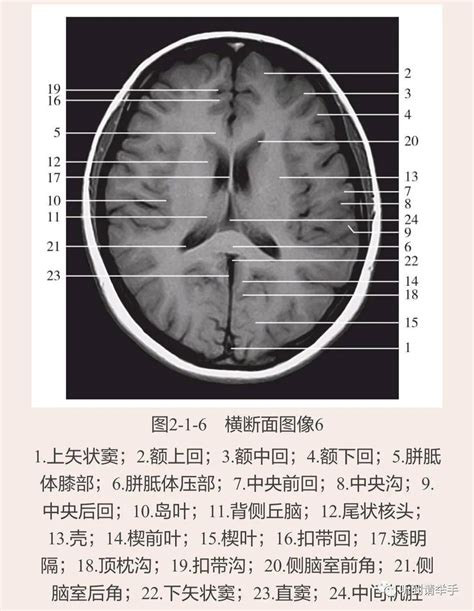 关于胼胝体发育不全 诊断