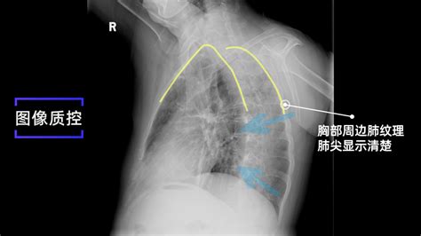 X线规范化检查 胸部左、右前斜位摄影（视频及图文详解）影像探测器胸椎