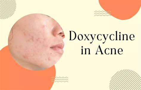 Decoding Doxycycline In Management Of Acne