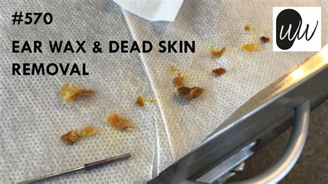 570 Ear Wax And Dead Skin Removal Youtube