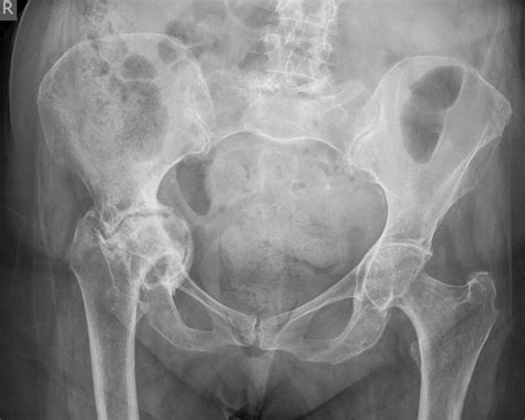 Protrusio Acetabuli Also Known As Acetabular Protrusion Is