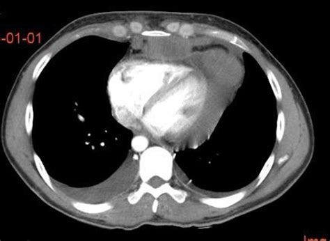 Derrame Pleural Recidivante Linfoma No Hodgkin Tomografia Ocronos The