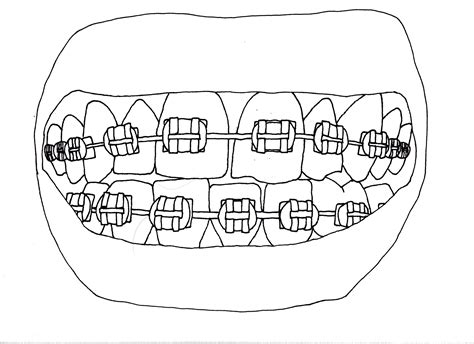 Amazing How To Draw Braces Check It Out Now Howdrawart1