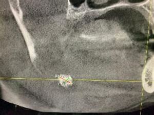 Sialolithiasis – Story of The Salivary Stone – Richardson's Plastic ...