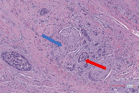 Histopathological Examination Of The Patient S Malignant Neoplasm With