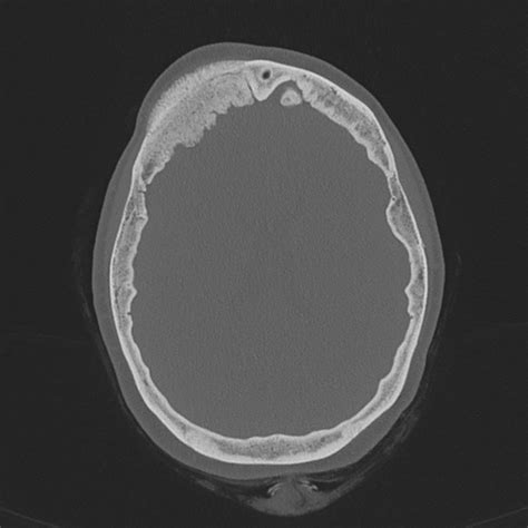 Meningioma Histology