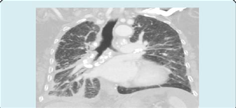 Multiple Pleural Based And Peri Bronchovascular Nodular Densities With