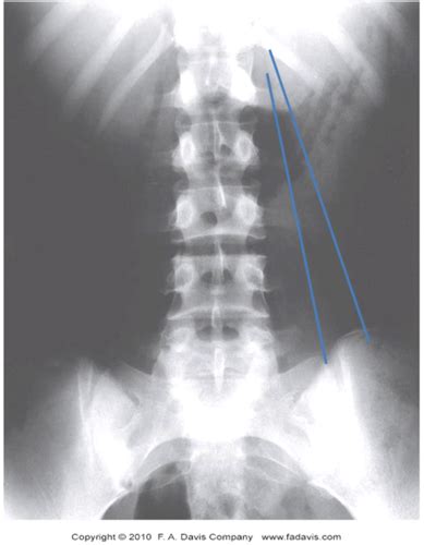 Imaging Of The Lumbar Spine Flashcards Quizlet