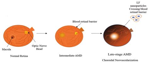 Age-related macular degeneration has different stages | Download Scientific Diagram