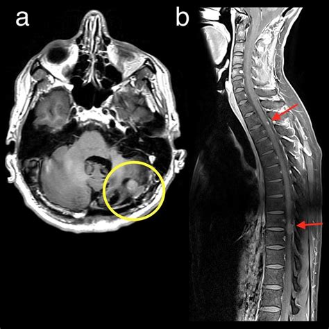 Axial T1 Post Contrast A And Sagittal T1 Post Contrast Fs