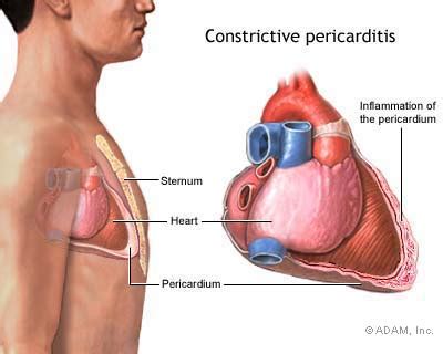 Pericarditis Constrictive Symptoms Diagnosis Treatment Of