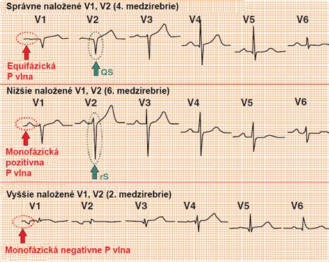 Av Predn Hemiblok Da Ekg Kniha Techmed