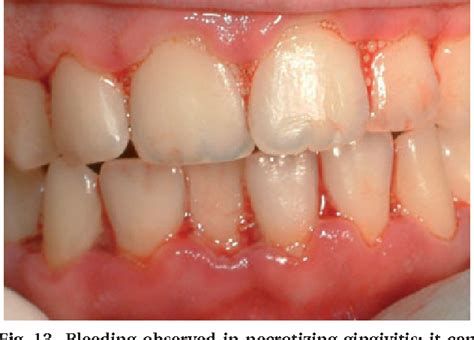 Figure From Acute Periodontal Lesions Semantic Scholar