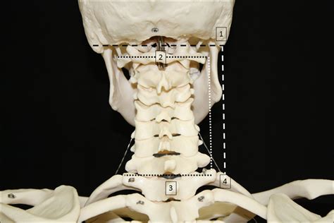 Skeletal Model With Delineated Marking For Anatomical Landmarks Used In