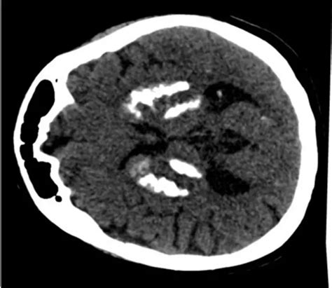 Ct Scan [image] Eurekalert Science News Releases