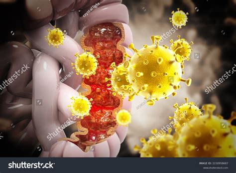 Colon Cancer Viral Infection Colon Disease Stock Illustration ...