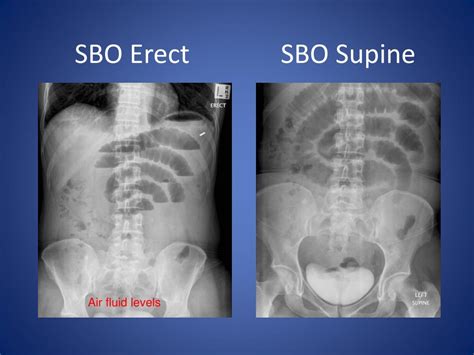 Ppt Abdominal X Ray Radiological Signs Powerpoint Presentation Free Download Id 6717699