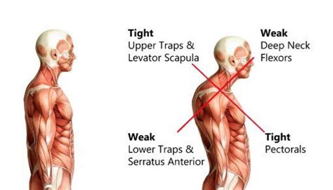 Forward Head Posture Muscles Involved