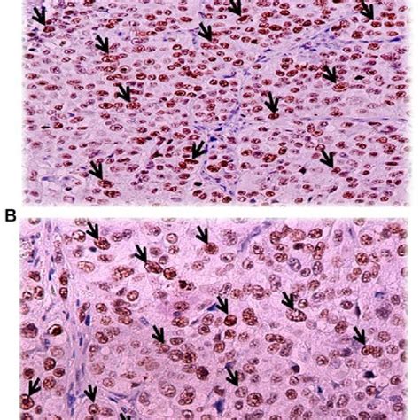 Positive Multifocal Nuclear Immunohistochemical Expression Of Survivin