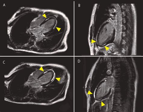 A series of contrast-enhanced MRI images of the heart Fig. 3A: The... | Download Scientific Diagram