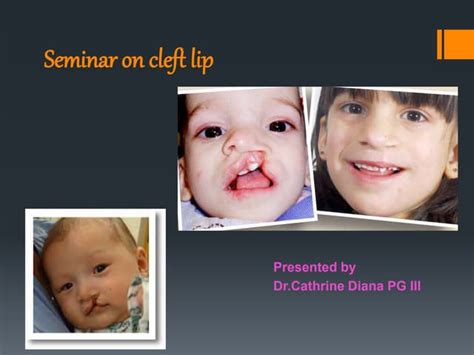 Cleft Lip Ppt