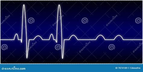 Abnormal Ekg Stock Illustration Illustration Of Care