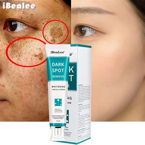 Freckle Cream Freckle Face Dark Spots On Skin Skin Spots Crema