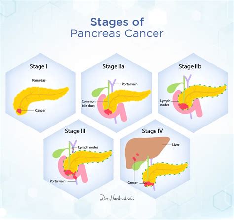 Dr Harsh Shah Best Pancreatic Cancer Hospital In Ahmedabad